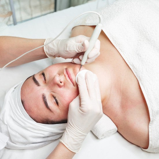 Ριζική αποτρίχωση με βελόνα